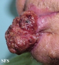 squamous cell carcinoma