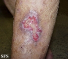 squamous cell carcinoma
