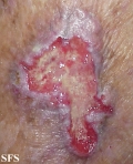 squamous cell carcinoma