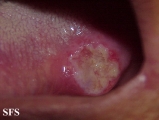 squamous cell carcinoma