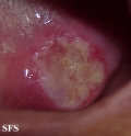 squamous cell carcinoma