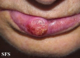 squamous cell carcinoma