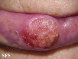 squamous cell carcinoma