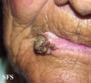 squamous cell carcinoma