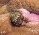squamous cell carcinoma