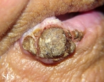 squamous cell carcinoma