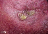 squamous cell carcinoma