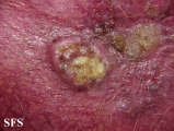 squamous cell carcinoma