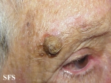 squamous cell carcinoma