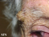 squamous cell carcinoma