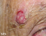 squamous cell carcinoma