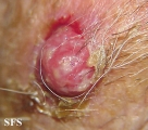 squamous cell carcinoma