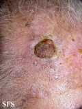 squamous cell carcinoma