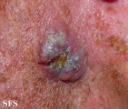 squamous cell carcinoma