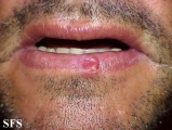 squamous cell carcinoma