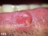 squamous cell carcinoma