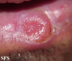 squamous cell carcinoma