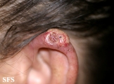 squamous cell carcinoma