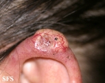 squamous cell carcinoma