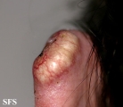 squamous cell carcinoma