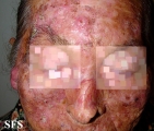 squamous cell carcinoma