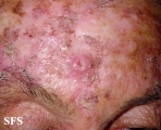 squamous cell carcinoma