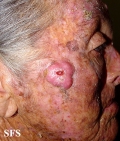 squamous cell carcinoma