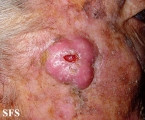 squamous cell carcinoma