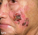 squamous cell carcinoma
