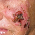 squamous cell carcinoma