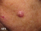 squamous cell carcinoma