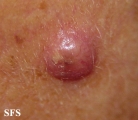 squamous cell carcinoma