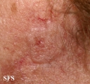 squamous cell carcinoma