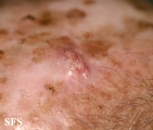 squamous cell carcinoma