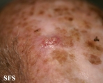 squamous cell carcinoma