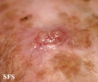 squamous cell carcinoma