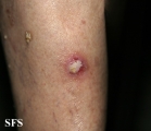 squamous cell carcinoma