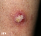 squamous cell carcinoma