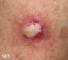 squamous cell carcinoma