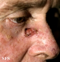 squamous cell carcinoma