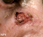 squamous cell carcinoma