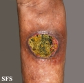 squamous cell carcinoma