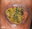 squamous cell carcinoma