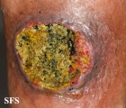squamous cell carcinoma