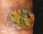 squamous cell carcinoma