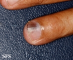 squamous cell carcinoma