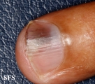 squamous cell carcinoma