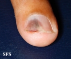 squamous cell carcinoma