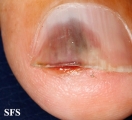 squamous cell carcinoma
