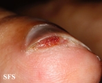 squamous cell carcinoma